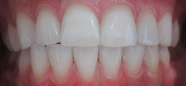 Teeth whitening dentist mould